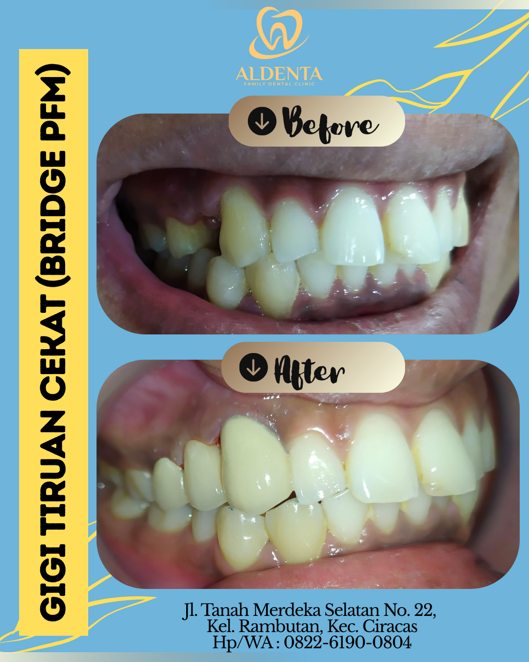 Gigi Tiruan Cekat (Bridge PFM)