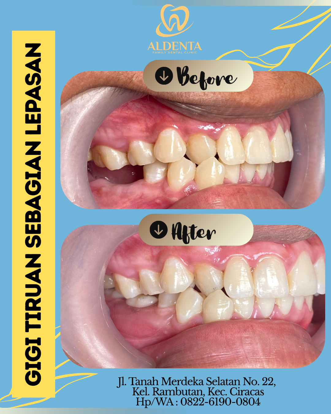 Gigi Tiruan Sebagian Lepasan