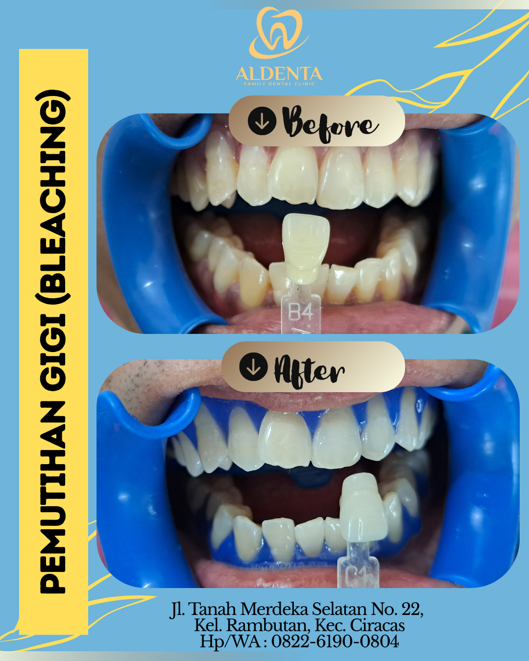 Pemutihan Gigi (Bleaching Gigi)