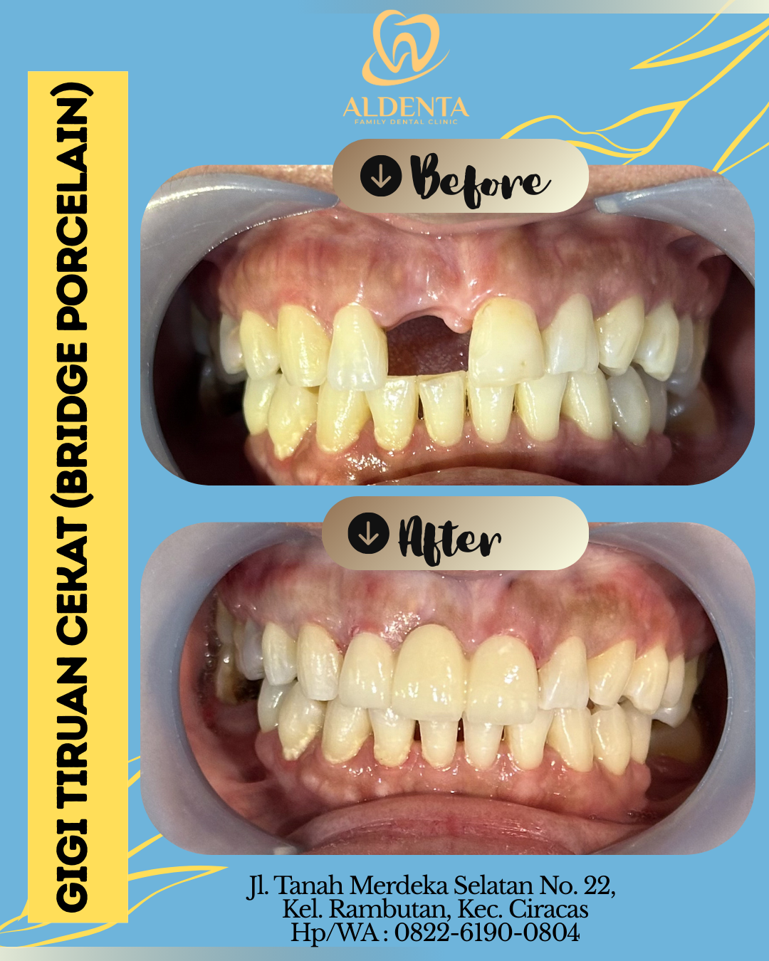 Gigi Tiruan Cekat (Bridge Porcelain)