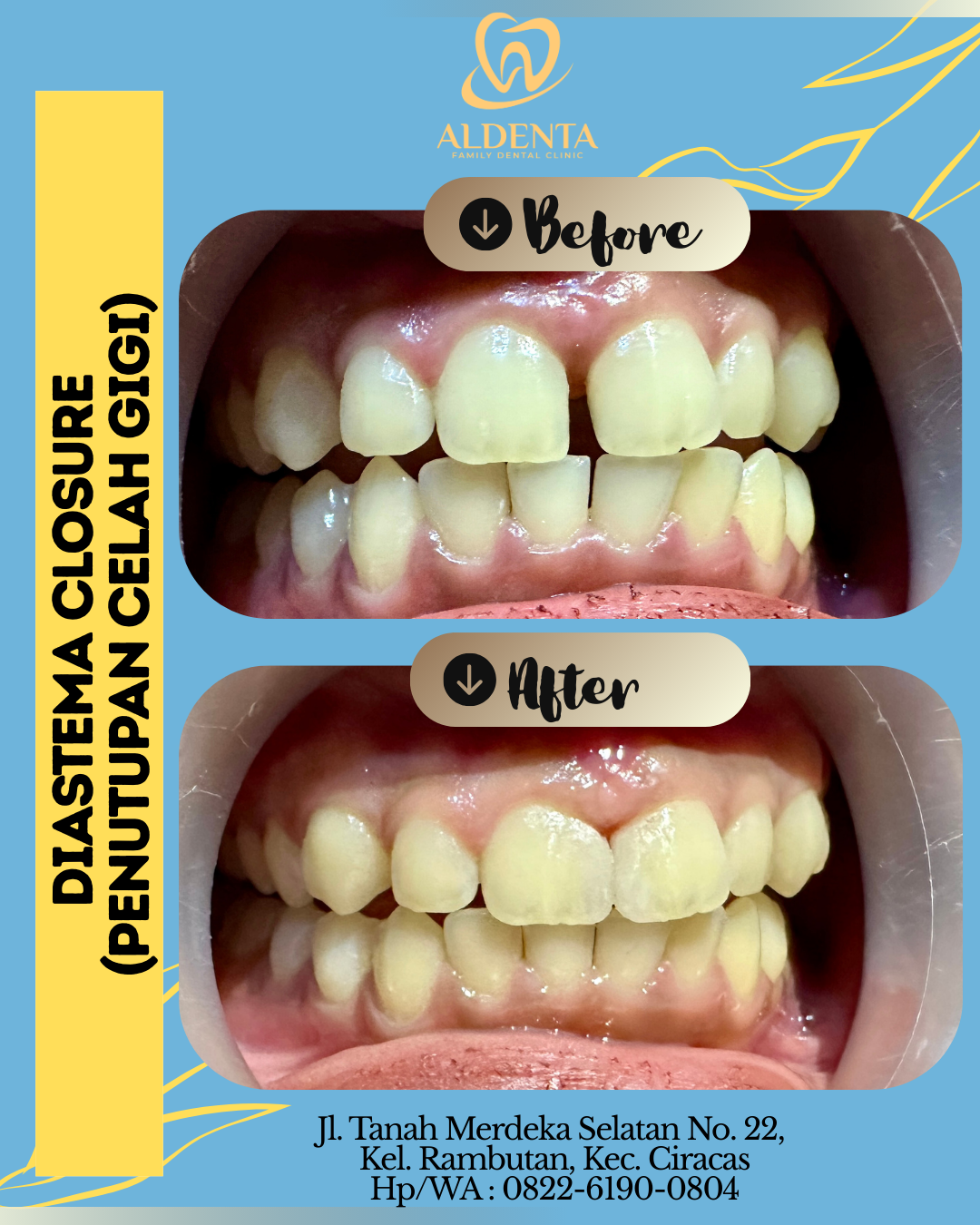 Diastema Closure / Penutupan Celah Gigi