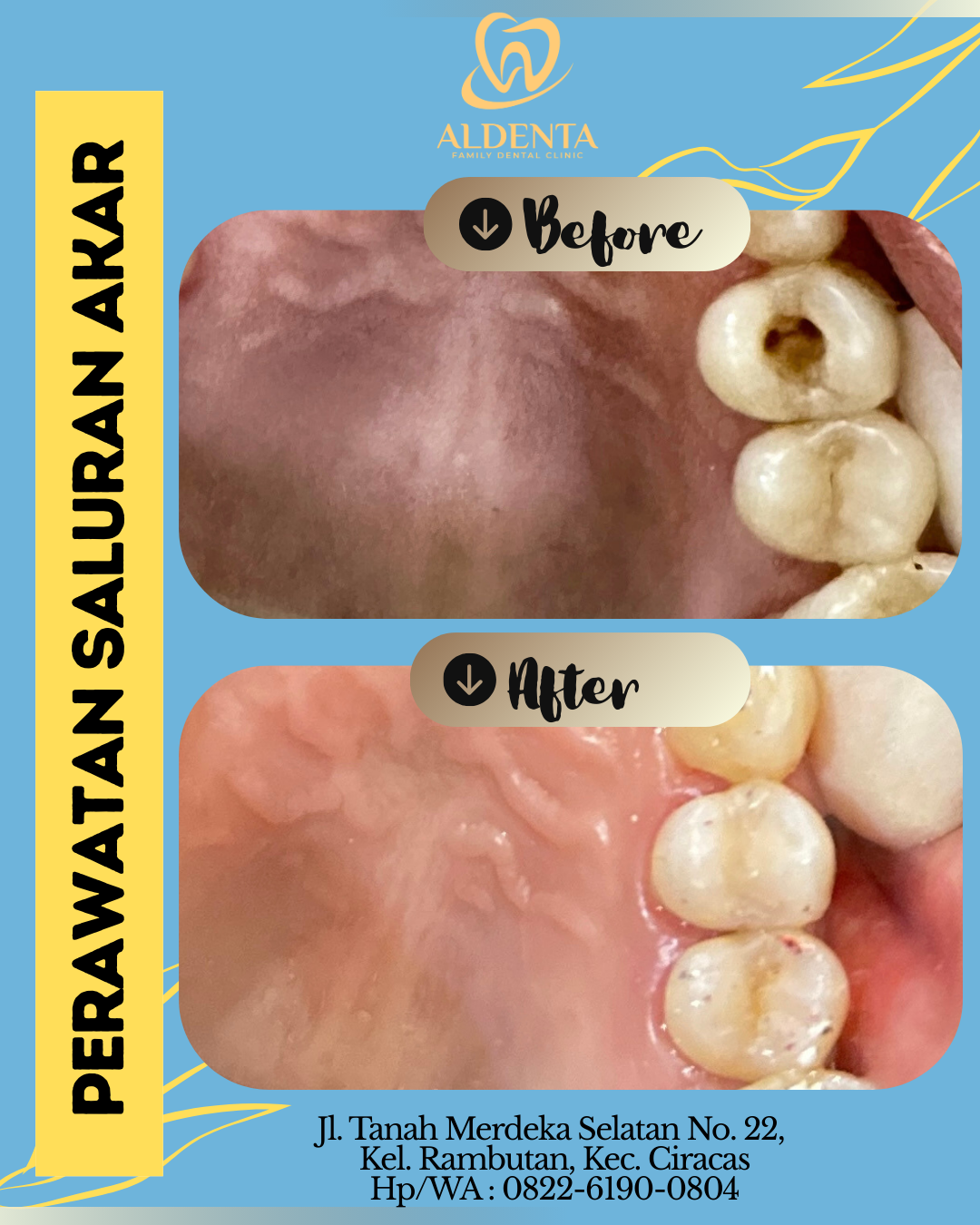 Perawatan Sluran Akar Gigi