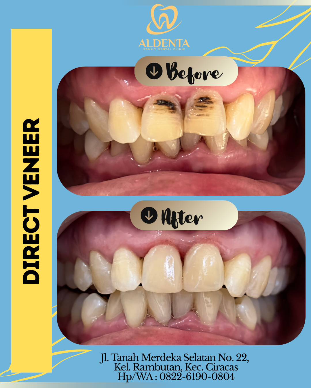 Veneer Direk Komposit