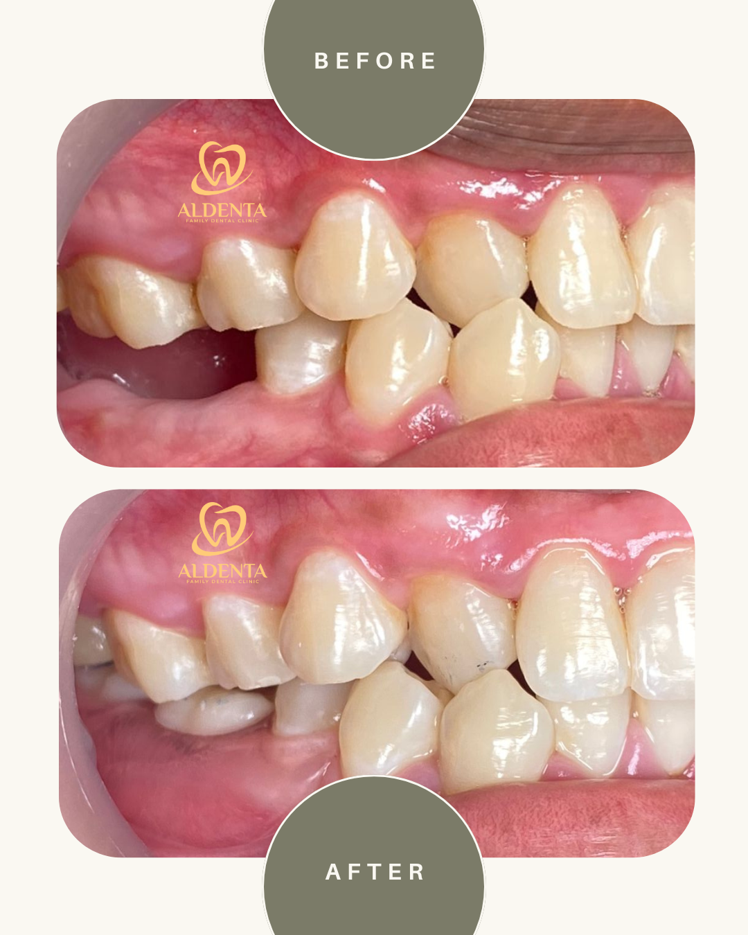 Gigi Tiruan Sebagian Lepasan