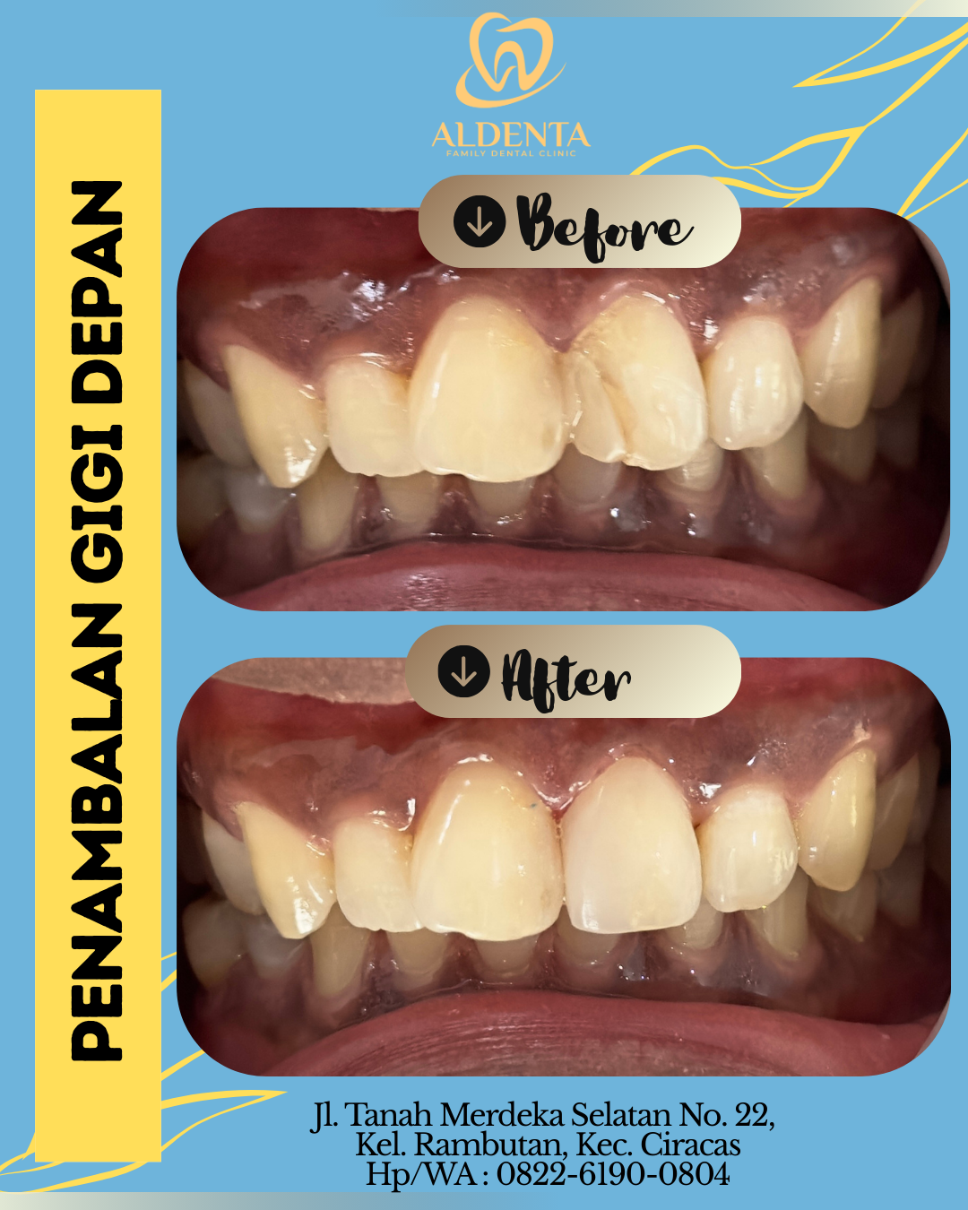 Penambalan Gigi Depan