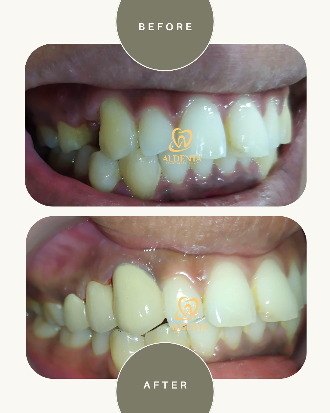 Gigi Tiruan Cekat / Bridge PFM