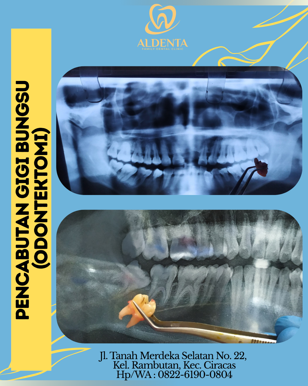 Odontektomi / Pencabutan Gigi Bungsu