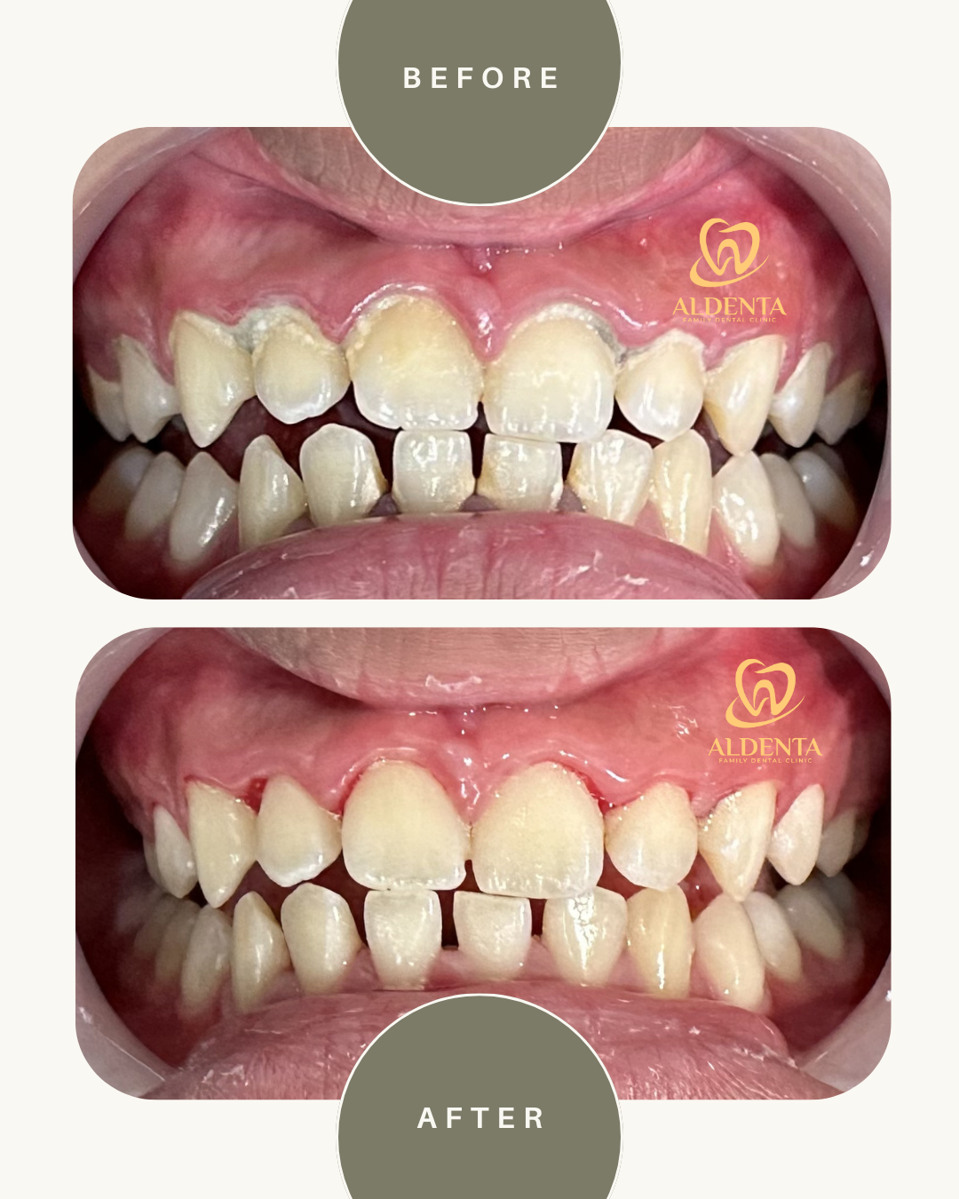 Pembersihan Karang Gigi / Scaling