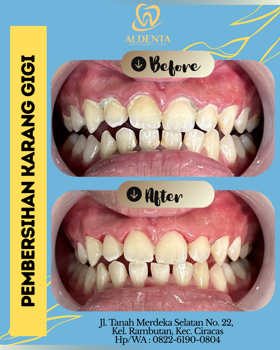 Pembersihan Karang Gigi (Scaling)