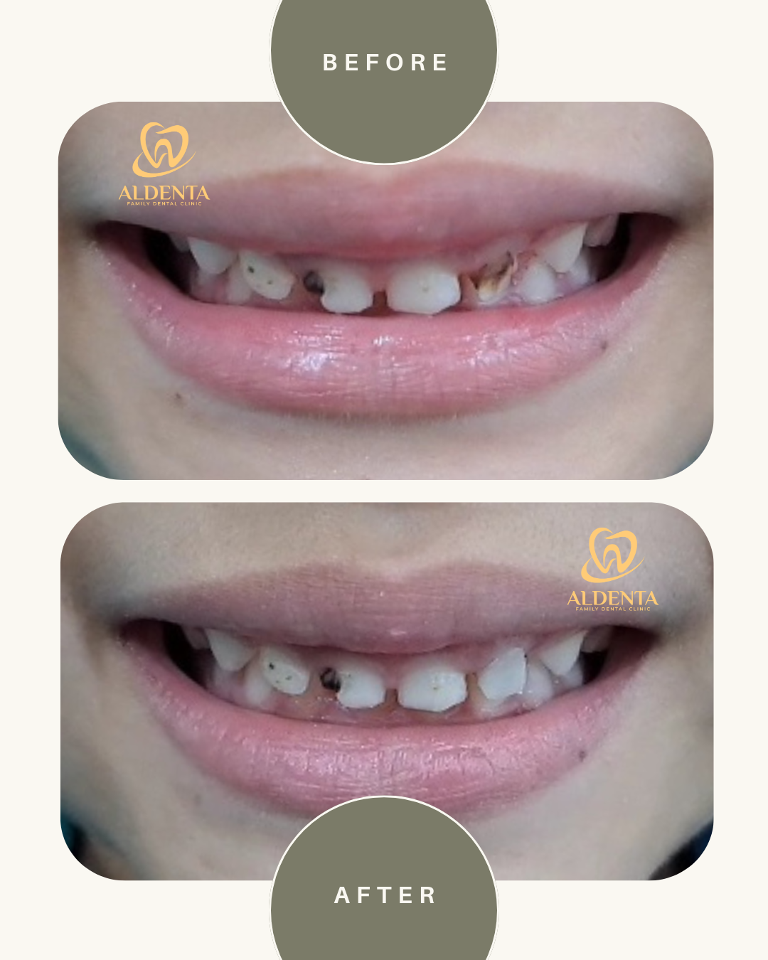 Perawatan Gigi Anak / Penambalan GIC