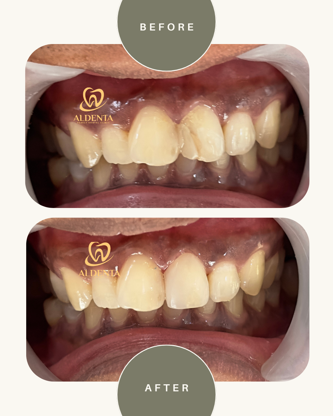 Penambalan Gigi Resin Komposit