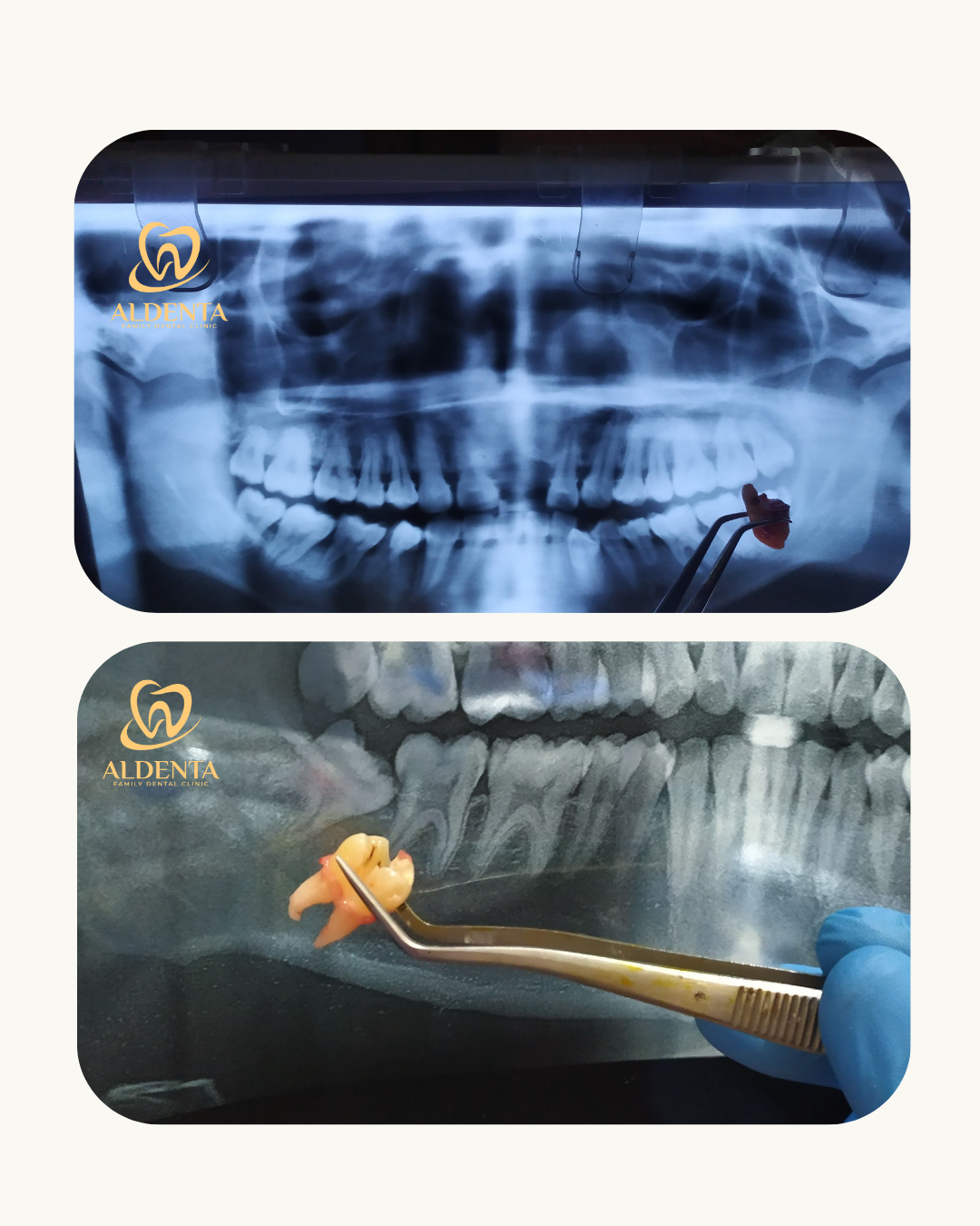 Odontektomi / Pencabutan Gigi Bungsu
