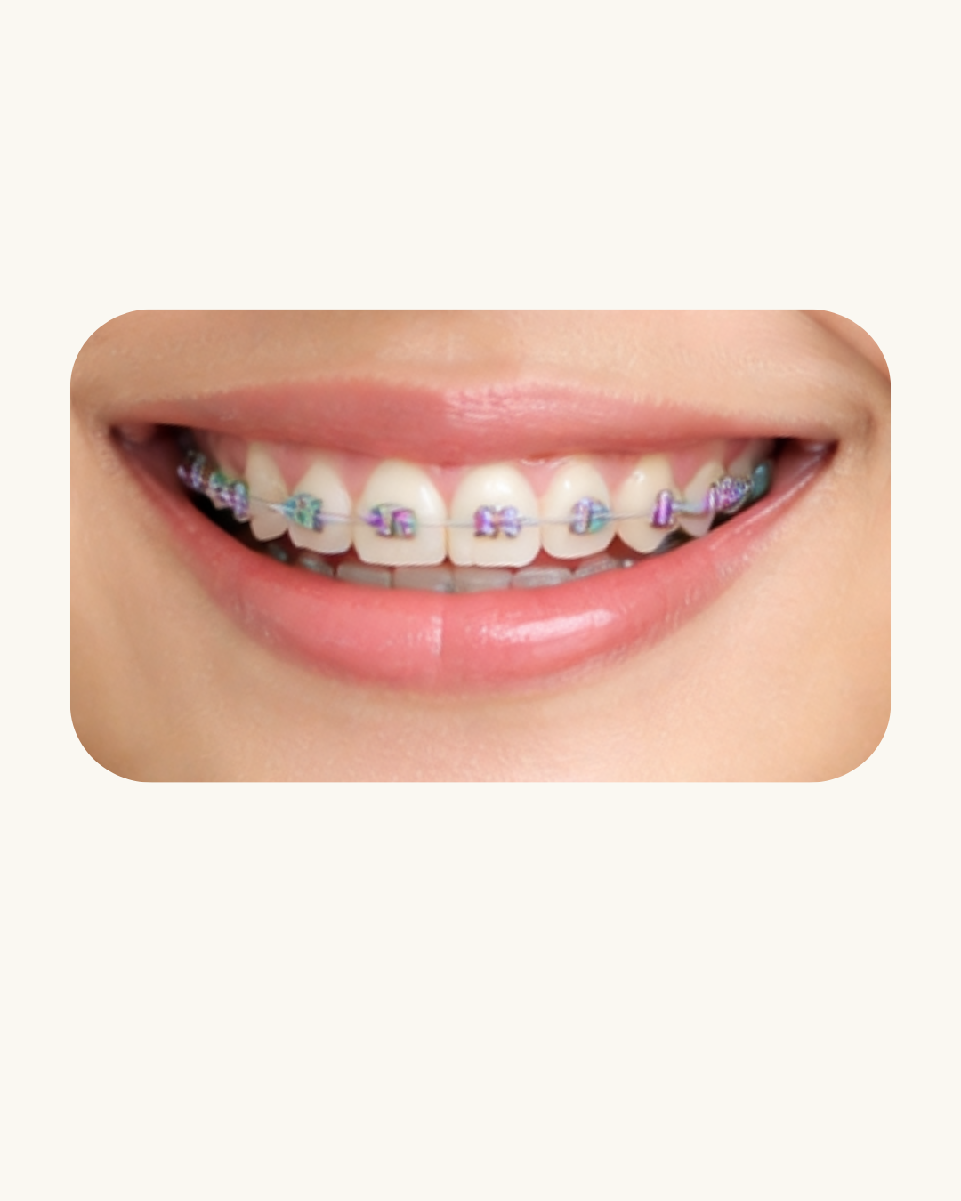 Orthodonti / Behel Gigi