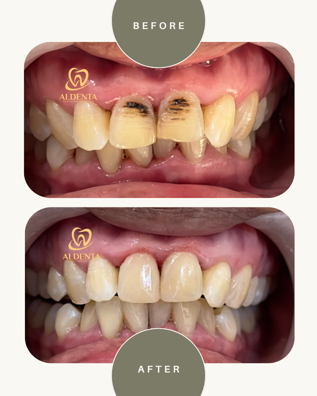 Direct Veneer