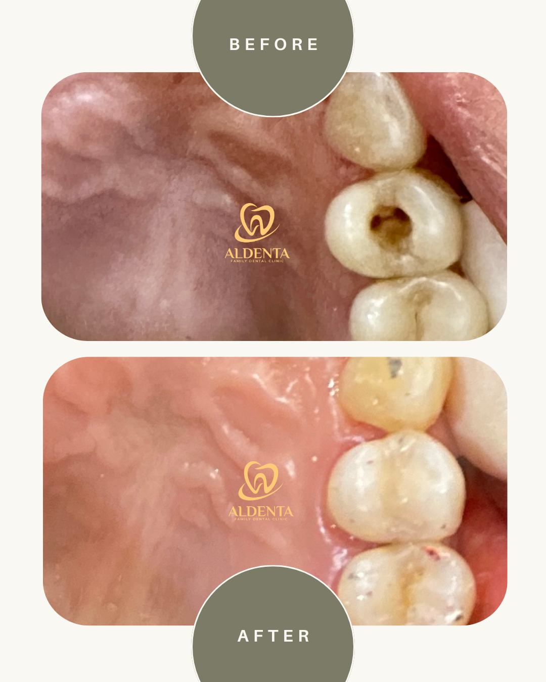 Perawatan Aluran Akar