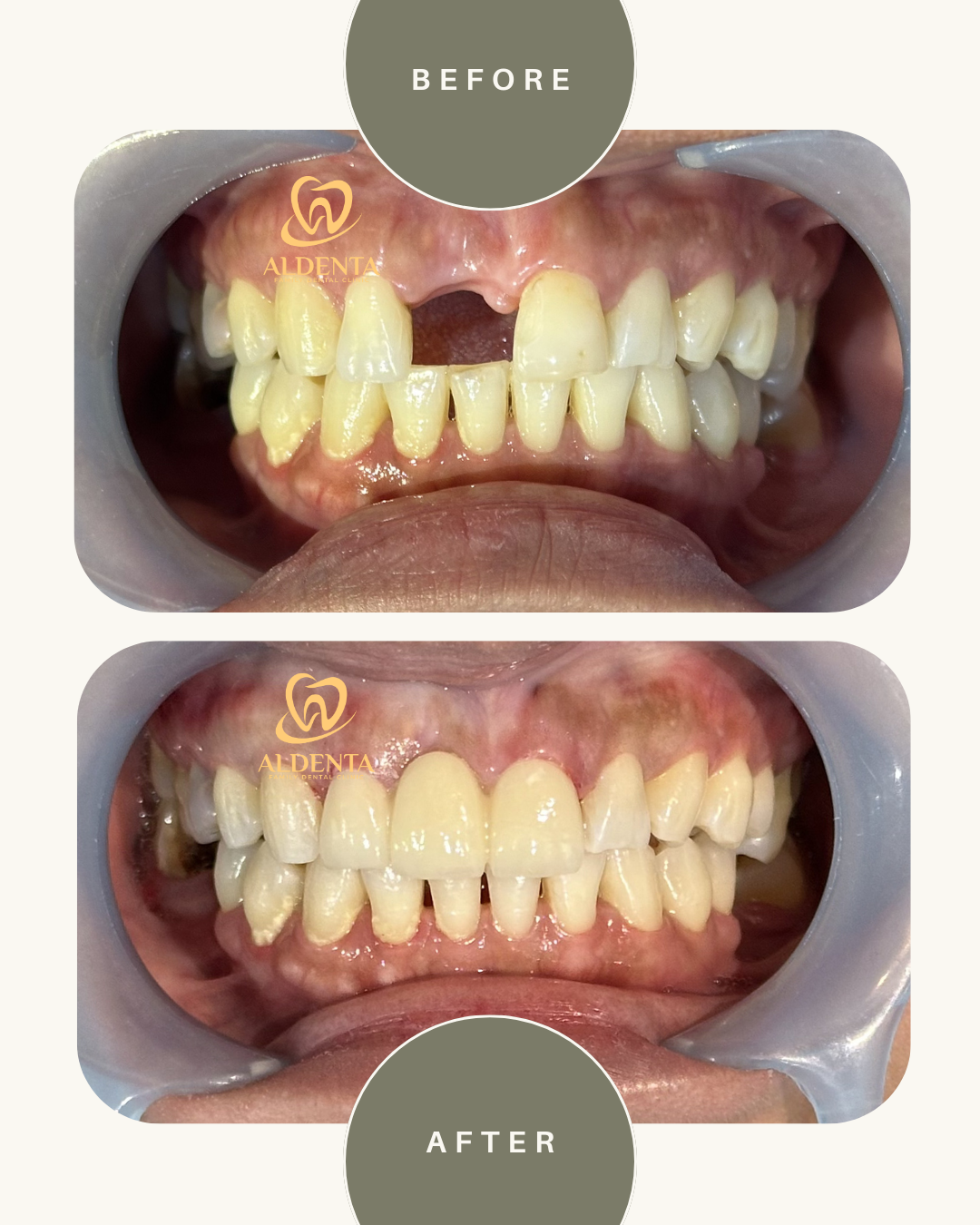 Gigi Tiruan Cekat / Bridge Porcelain